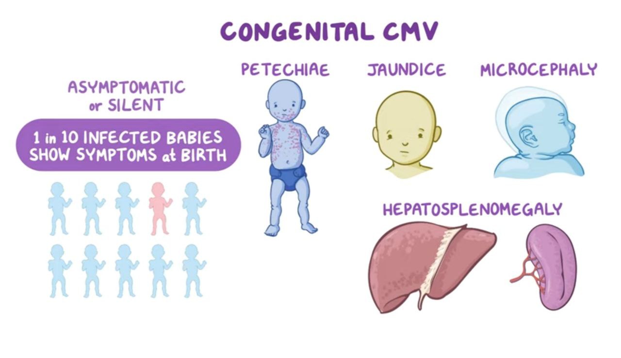 علائم سیتومگالوویروس در نوزادان